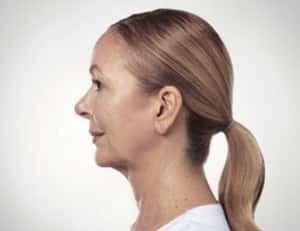 Kybella, Somenek + Pittman MD, Washington D.C.