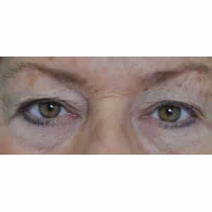 Real patient Blepharoplasty by Dr.Somenek, Washington D.C.
