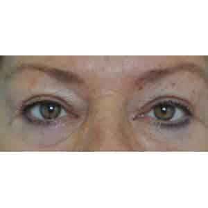 Real patient Blepharoplasty by Dr.Somenek, Washington D.C.