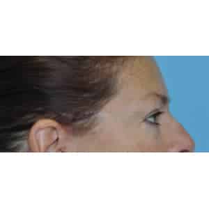 Real patient Blepharoplasty by Dr.Somenek, Washington D.C.