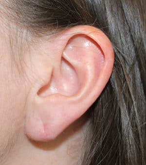 Real patient Earlobe Repair by Dr.Somenek, Washington D.C.