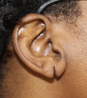 Real patient Earlobe Repair by Dr.Somenek, Washington D.C.