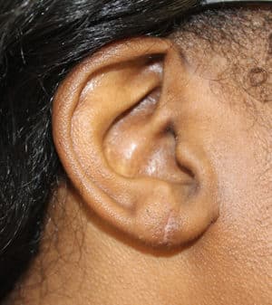 Real patient Earlobe Repair by Dr.Somenek, Washington D.C.