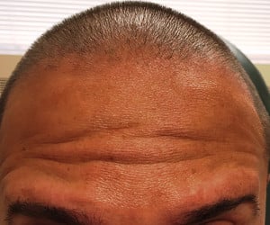 Real Patient Botox, Somenek + Pittman MD, Washington D.C.
