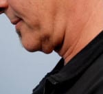 Real patient Facetite, Somenek + Pittman MD, Washington D.C.