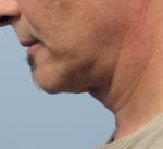 Real patient Facetite, Somenek + Pittman MD, Washington D.C.
