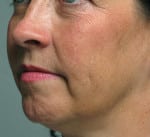 Real patient Facetite, Somenek + Pittman MD, Washington D.C.