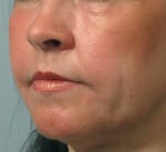 Real patient Facetite, Somenek + Pittman MD, Washington D.C.