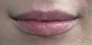 Real Patient Lip Augmentation, Somenek + Pittman MD, Washington D.C.