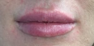 Real Patient Lip Augmentation, Somenek + Pittman MD, Washington D.C.