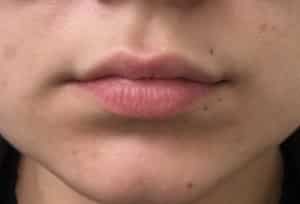 Real Patient Lip Augmentation, Somenek + Pittman MD, Washington D.C.