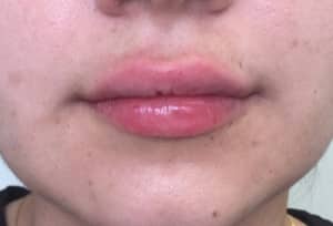 Real Patient Lip Augmentation, Somenek + Pittman MD, Washington D.C.