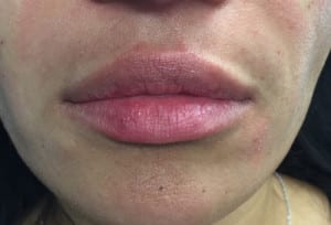 Real Patient Lip Augmentation, Somenek + Pittman MD, Washington D.C.