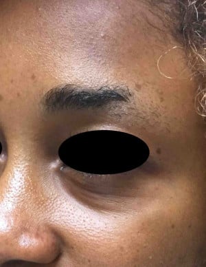 Real patient Filler, Somenek + Pittman MD, Washington D.C.