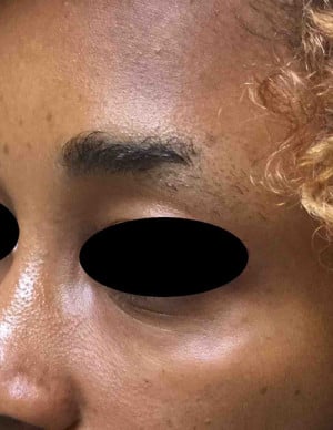 Real patient Filler, Somenek + Pittman MD, Washington D.C.