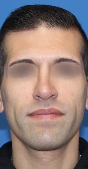 Real patient Rhinoplasty by Dr.Somenek, Washington D.C.