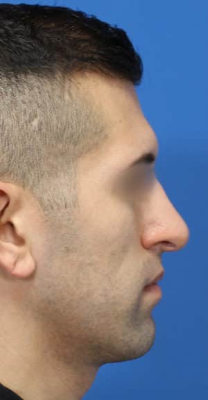 Real patient Rhinoplasty by Dr.Somenek, Washington D.C.