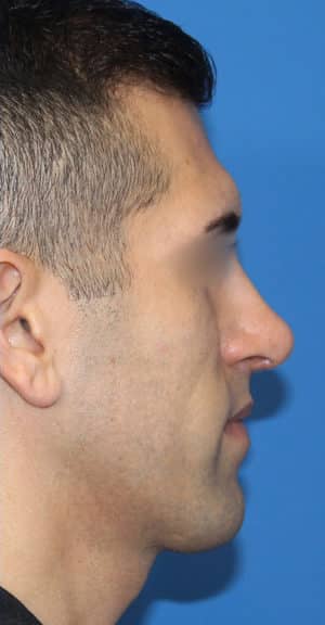 Real patient Rhinoplasty by Dr.Somenek, Washington D.C.
