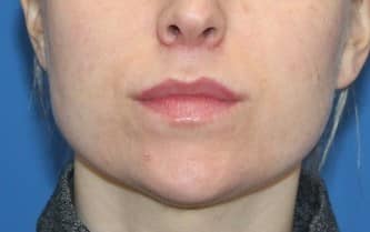 Real patient Upper Lip Lift by Dr.Somenek, Washington D.C.