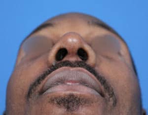 Real patient Rhinoplasty by Dr.Somenek, Washington D.C.