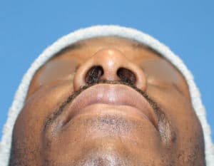 Real patient Rhinoplasty by Dr.Somenek, Washington D.C.