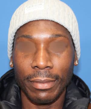 Real patient Rhinoplasty by Dr.Somenek, Washington D.C.