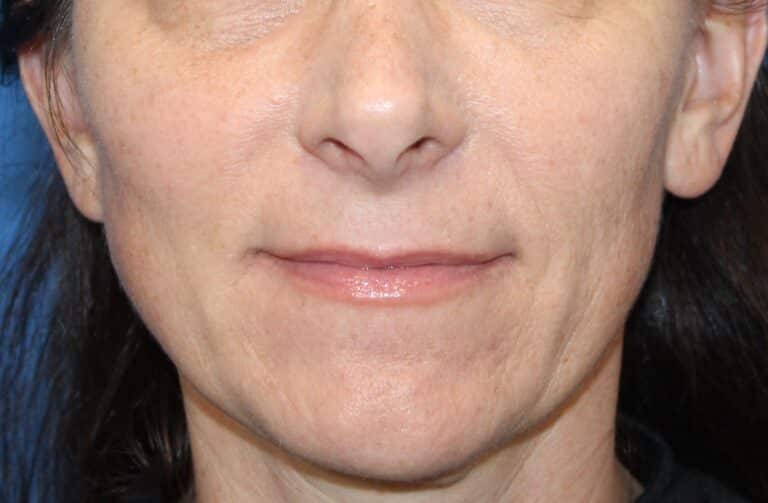 Real patient Upper Lip Lift by Dr.Somenek, Washington D.C.