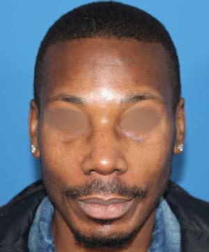 Real patient Rhinoplasty by Dr.Somenek, Washington D.C.