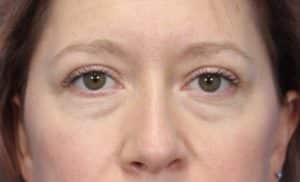 Real patient Blepharoplasty by Dr.Somenek, Washington D.C.