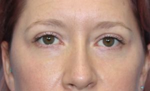 Real patient Blepharoplasty by Dr.Somenek, Washington D.C.