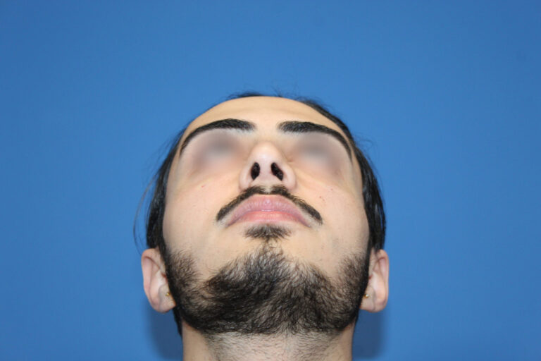 Real patient Rhinoplasty by Dr.Somenek, Washington D.C.