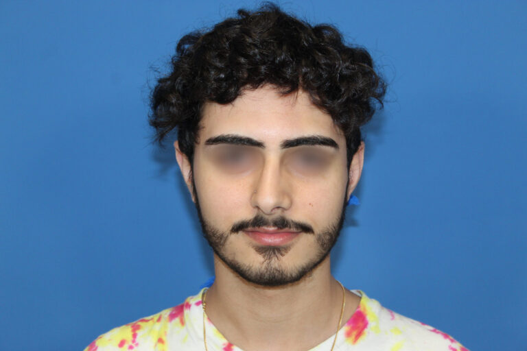 Real patient Rhinoplasty by Dr.Somenek, Washington D.C.