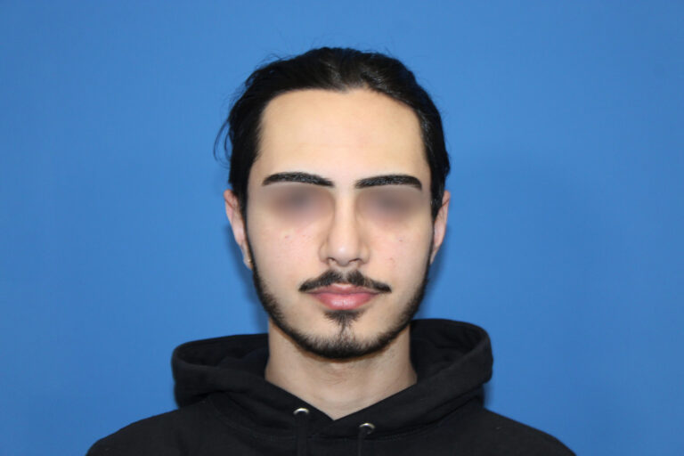 Real patient Rhinoplasty by Dr.Somenek, Washington D.C.