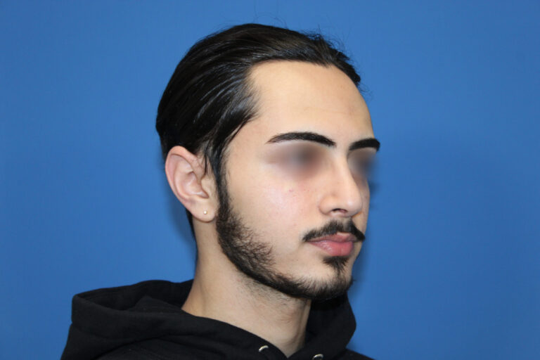 Real patient Rhinoplasty by Dr.Somenek, Washington D.C.