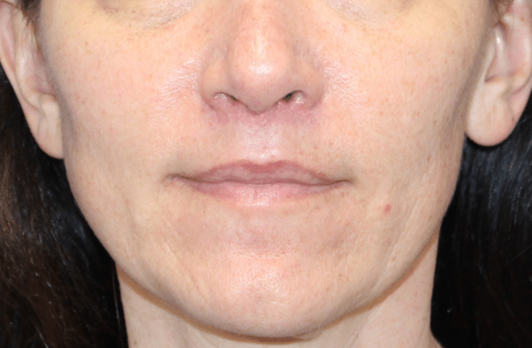 Real patient Upper Lip Lift by Dr.Somenek, Washington D.C.