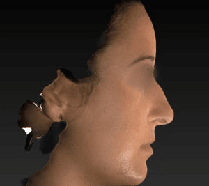 Real patient Rhinoplasty by Dr.Somenek, Washington D.C.