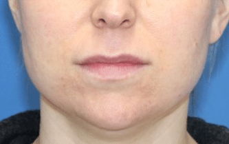 Real patient Upper Lip Lift by Dr.Somenek, Washington D.C.