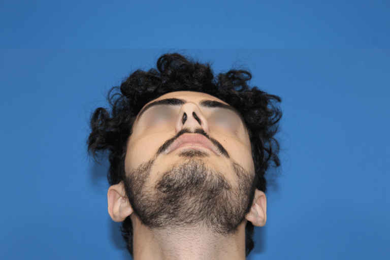 Real patient Rhinoplasty by Dr.Somenek, Washington D.C.