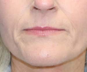 Real patient Upper Lip Lift by Dr.Somenek, Washington D.C.