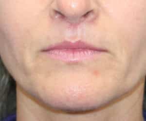 Real patient Upper Lip Lift by Dr.Somenek, Washington D.C.