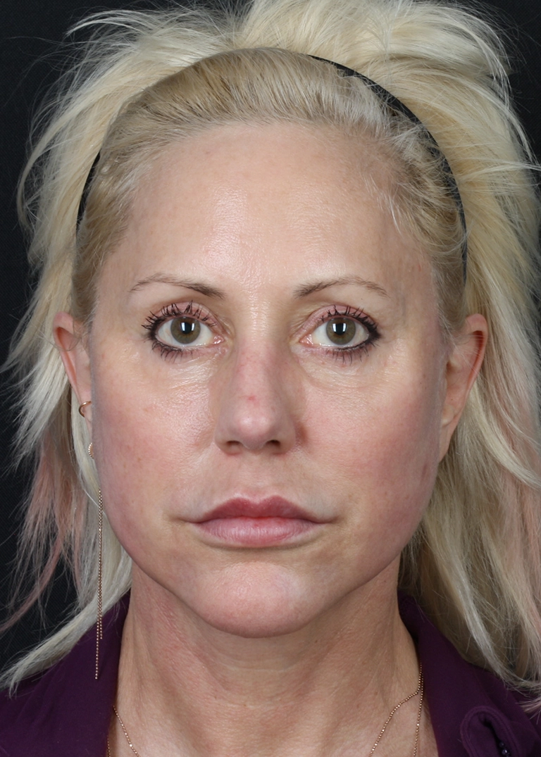 15250-facelift-necklift-02