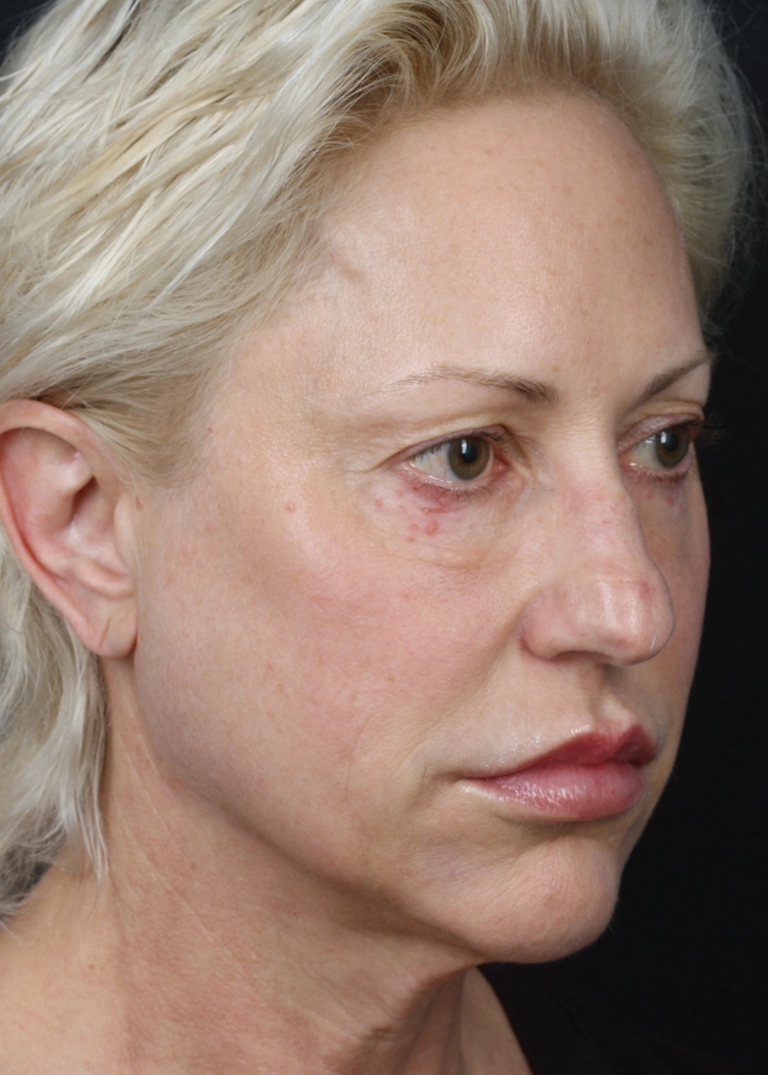 15250-facelift-necklift-03