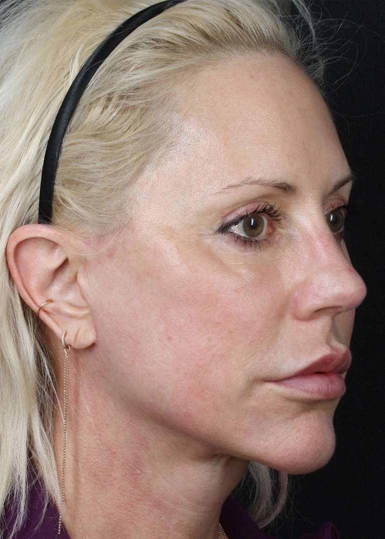 15250-facelift-necklift-04