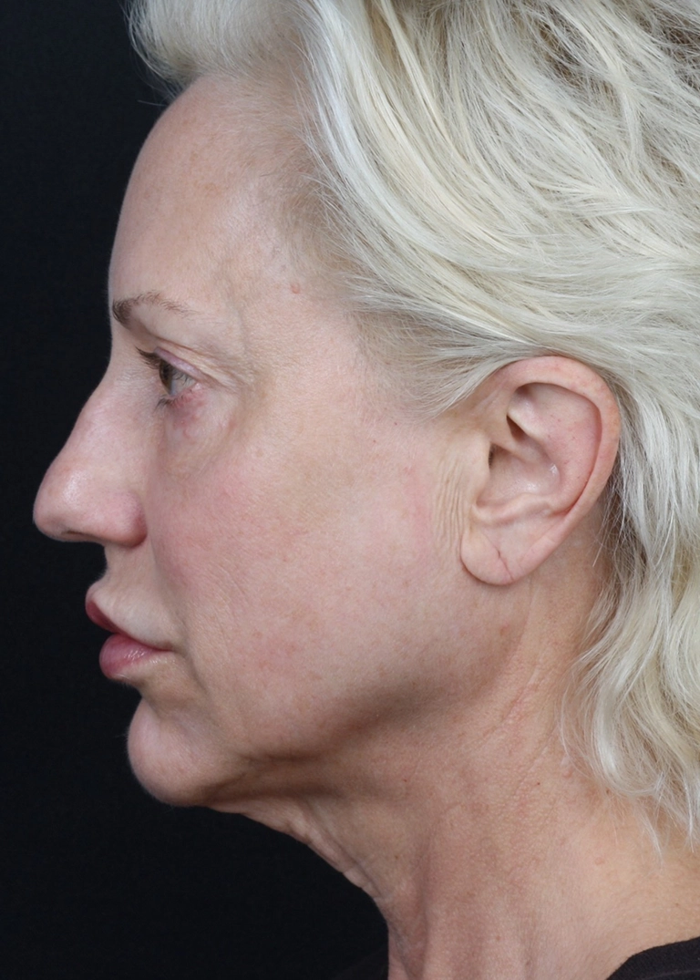 15250-facelift-necklift-05