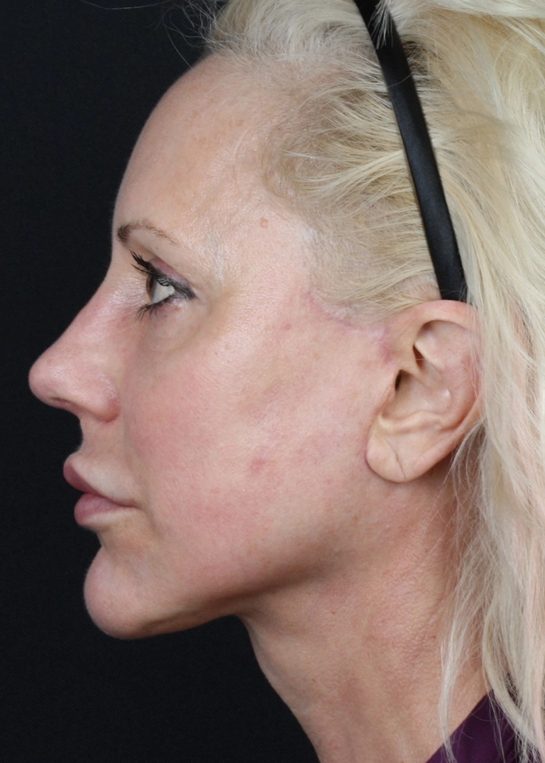 15250-facelift-necklift-06