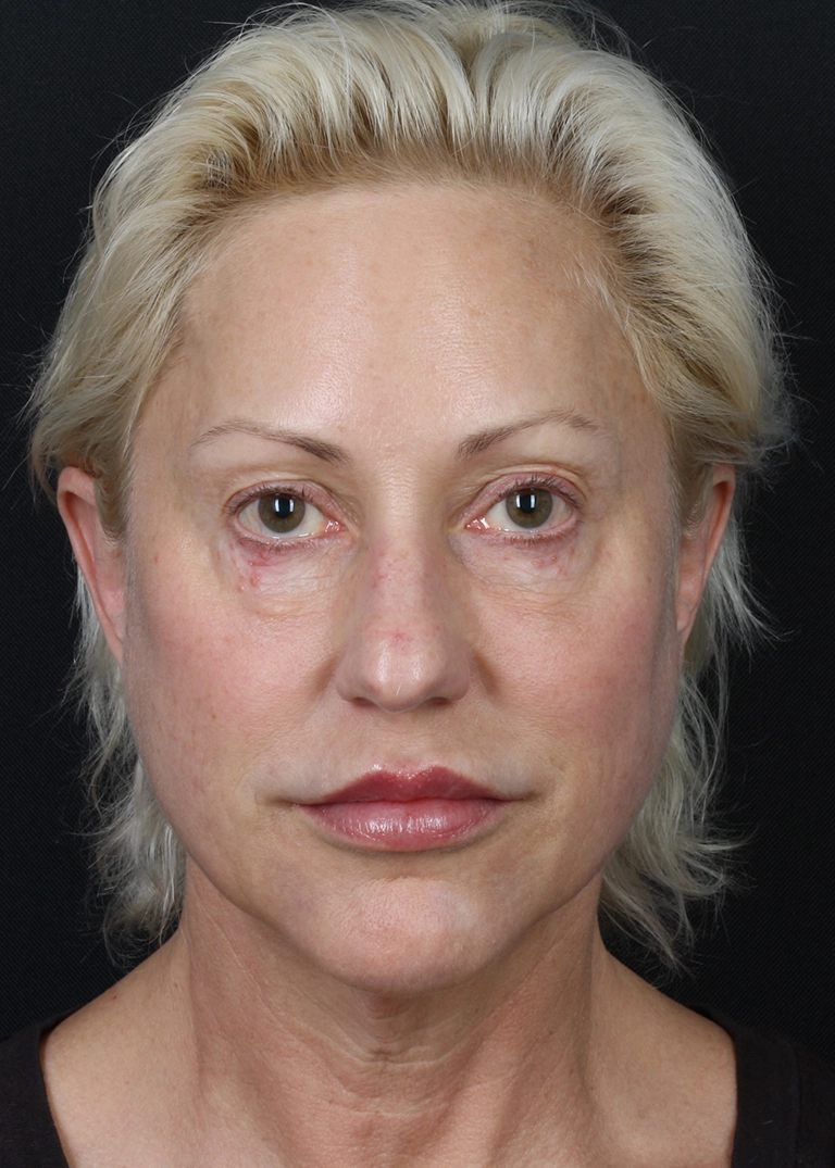 15250-facelift-necklift-before-01