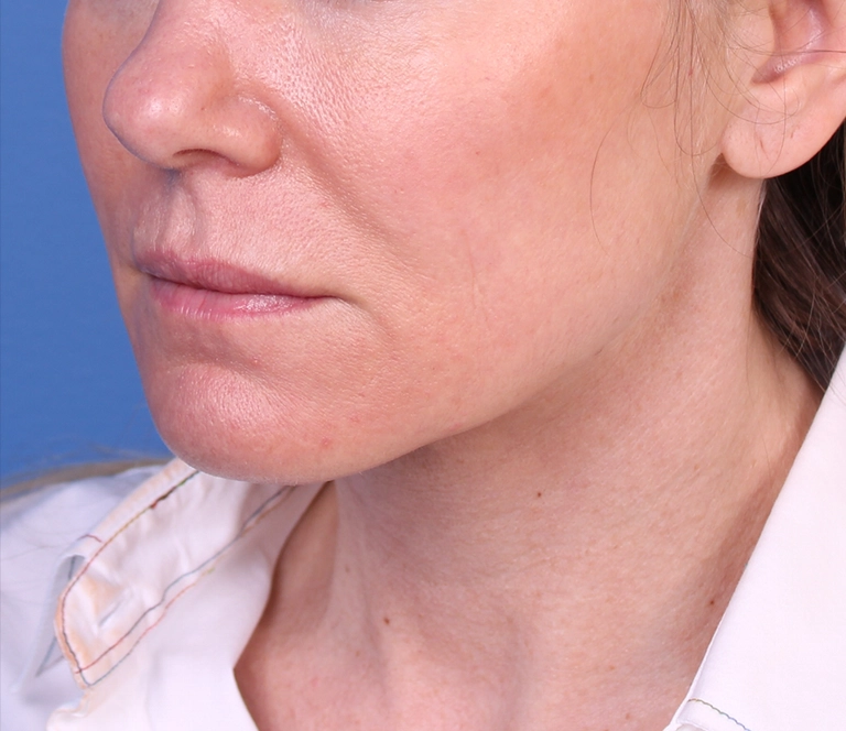 15262-facelift-necklift-03