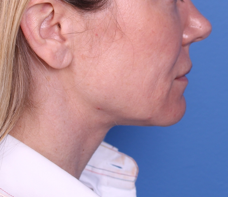 15262-facelift-necklift-05