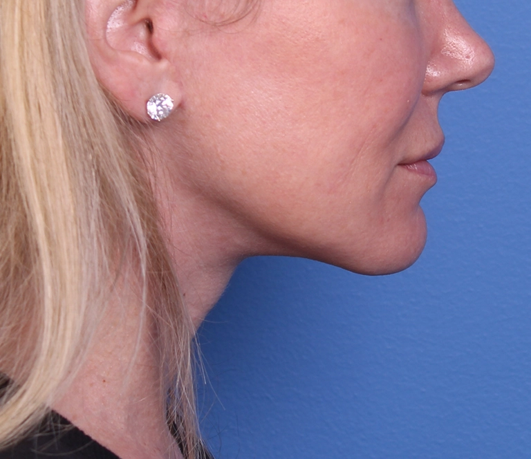 15262-facelift-necklift-06