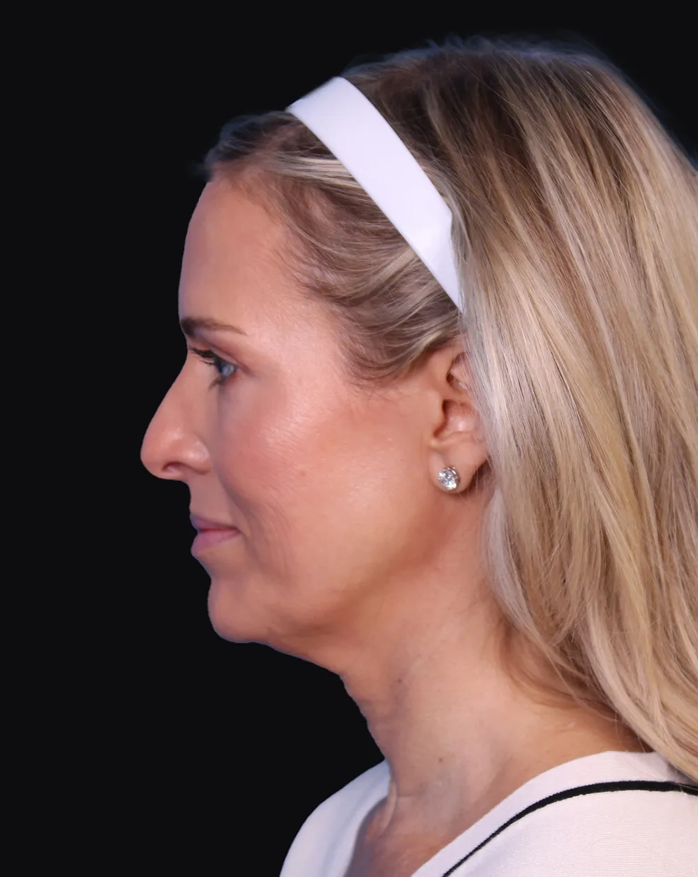facelift-necklift-01-BN (3) 8-weeks